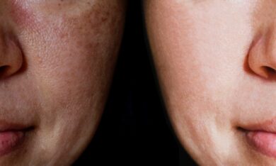 Tác dụng ‘ngoài mong muốn’ khi thải độc bằng Glutathione