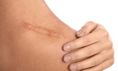 Cơ địa tốt có được chủ quan với vết thương trên da?
