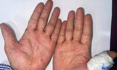 Phát hiện ung thư da từ dấu hiệu lạ lòng bàn tay