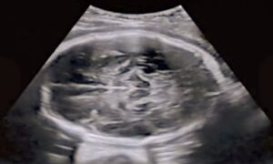 Cực kỳ hy hữu: Người phụ nữ sắp sinh mới biết đang mang bầu