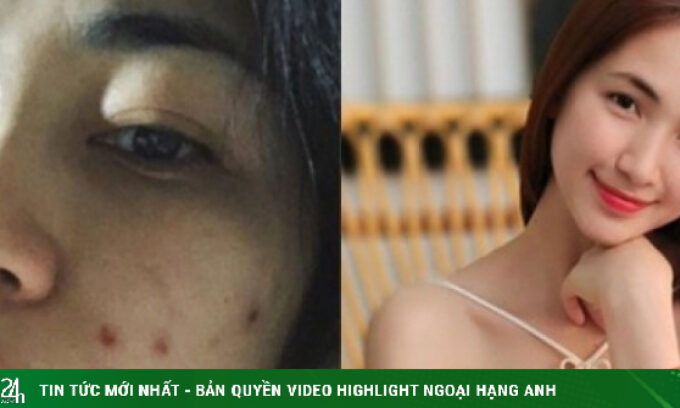 Hòa Minzy sạch mụn nhờ loại rau được người Nhật ví như ‘rau giải độc’, bán đầy ở chợ Việt