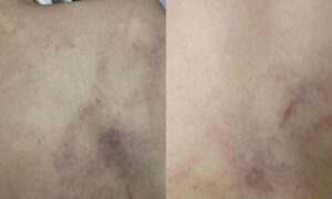 Phụ huynh Hà Nội tố giáo viên đánh trẻ mầm non bầm tím lưng
