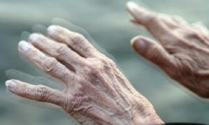 Khiếm khuyết vận động thường gặp ở người bệnh Parkinson