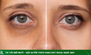 Nhiều người bị quầng thâm mắt mà không biết đây có thể là dấu hiệu của nhiều bệnh nguy hiểm