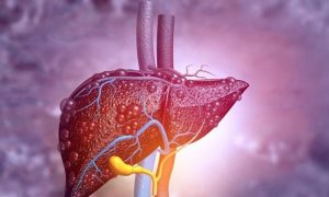 Thiếu nữ 16 tuổi tăng 40kg sau một năm, gan bị mỡ ‘xâm chiếm’